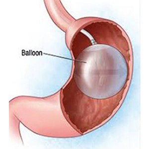 Intragastric Balloon Placement For Weight Loss 
