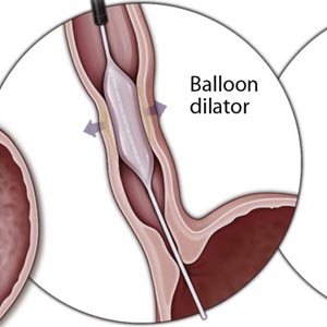 Stricture Dilatation