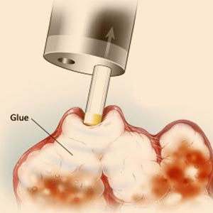 Endoscopic Glue Injection