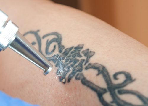 Laser Tattoo Removal In Raipur